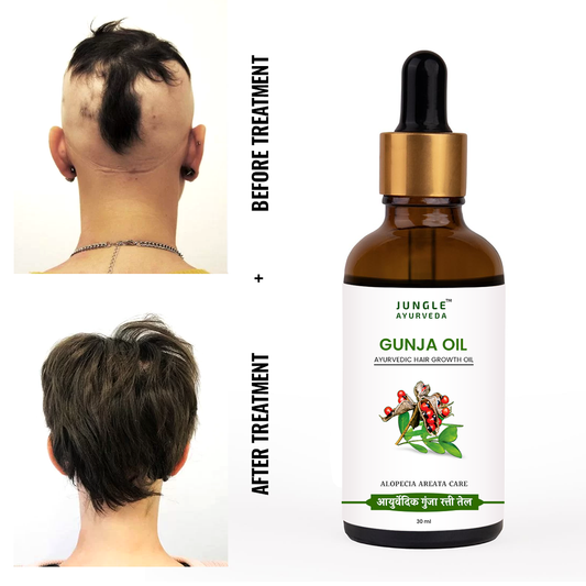 Gunja Oil for Hair Growth & Alopecia care | For Hair Fall Control, Scalp Treatment for Strong & Healthy Hair | For Men & Women 30 ml