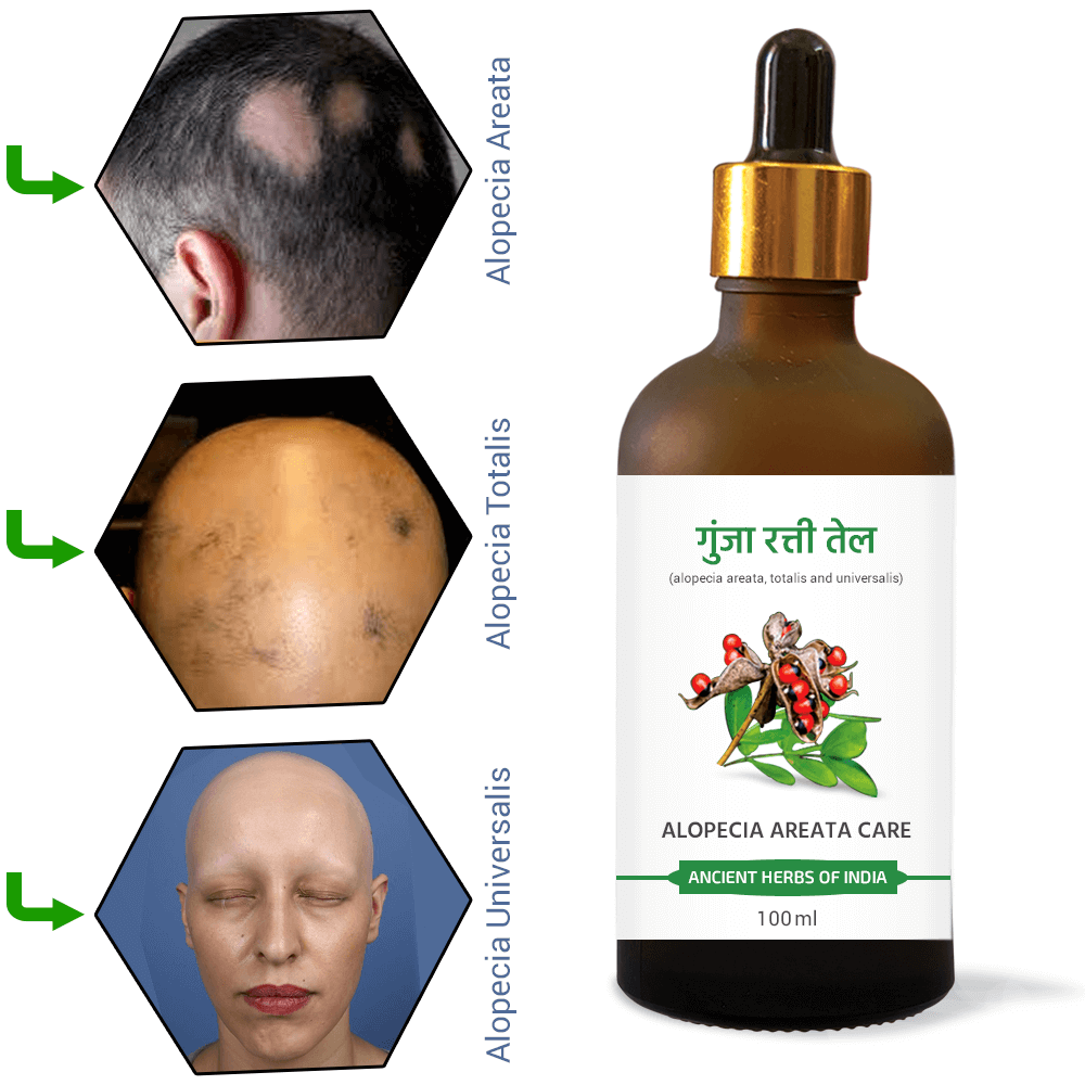 Gunja Oil for Hair Growth & Alopecia care | For Hair Fall Control, Scalp Treatment for Strong & Healthy Hair | For Men & Women 100ml