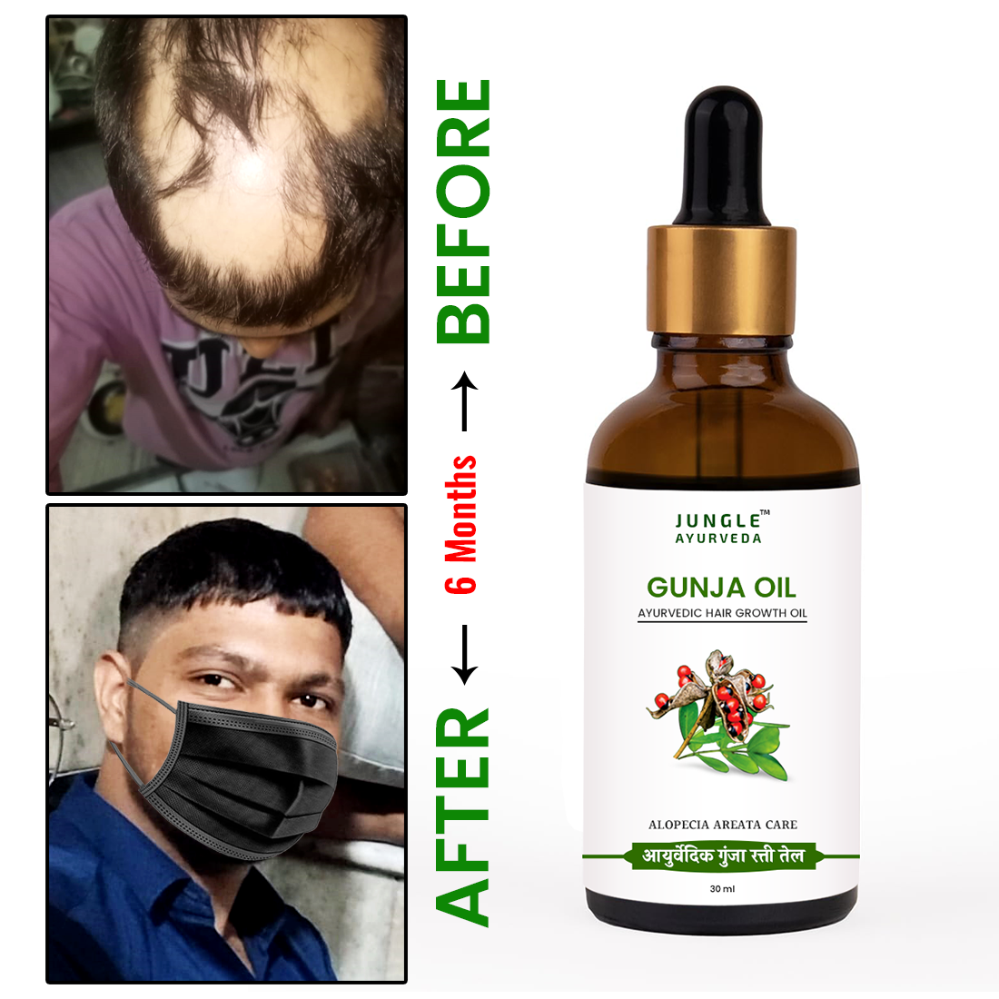 Gunja Oil for Hair Growth & Alopecia care | For Hair Fall Control, Scalp Treatment for Strong & Healthy Hair | For Men & Women 30 ml